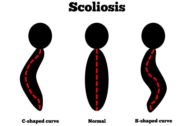 Grand Forks, ND scoliosis treatment